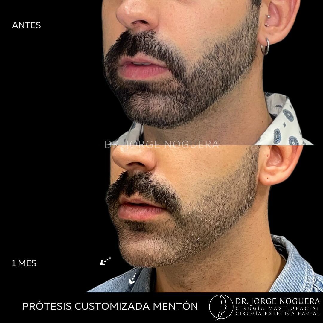 Aumento mentón Antes y después - Multiestetica.com - Multiestetica.com