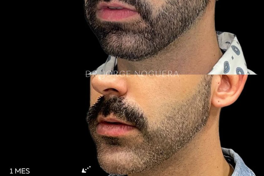 Aumento mentón antes y después - 862905