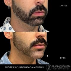 Mentoplastia - Dr. Jorge Noguera