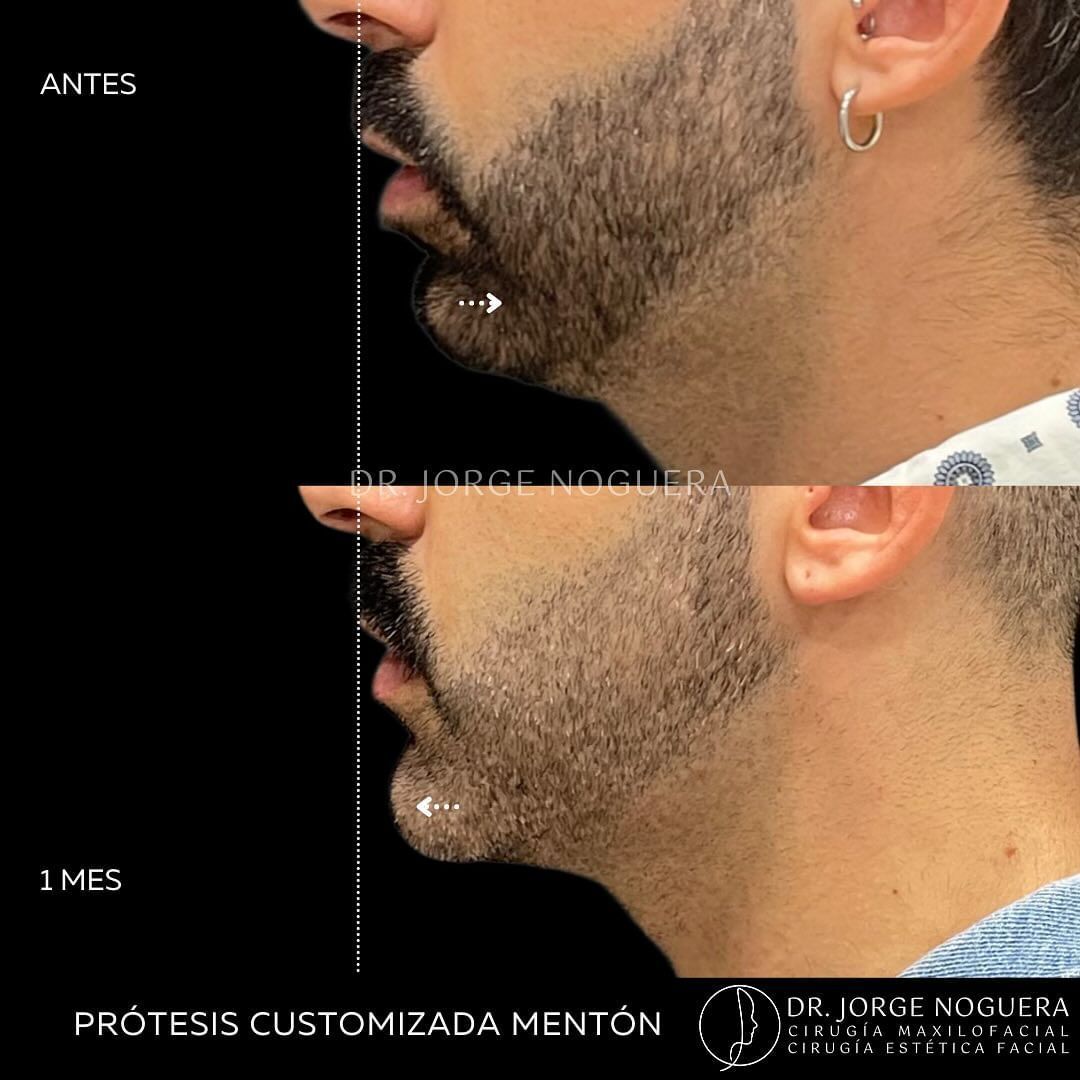 Aumento mentón Antes y después - Multiestetica.com - Multiestetica.com