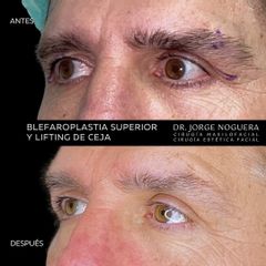 Blefaroplastia - Dr. Jorge Noguera