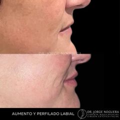 Aumento labios - Dr. Jorge Noguera
