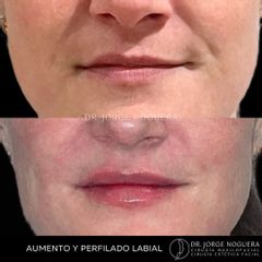 Aumento de labios - Dr. Jorge Noguera