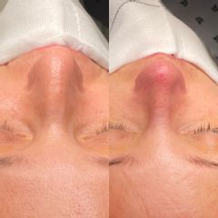 Rinoplastia - Dr. Alberto Cuevas