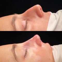 Rinoplastia - Dr. Alberto Cuevas
