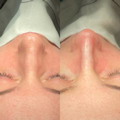 Rinoplastia - Dr. Alberto Cuevas