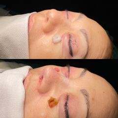 Rinoplastia - Dr. Alberto Cuevas