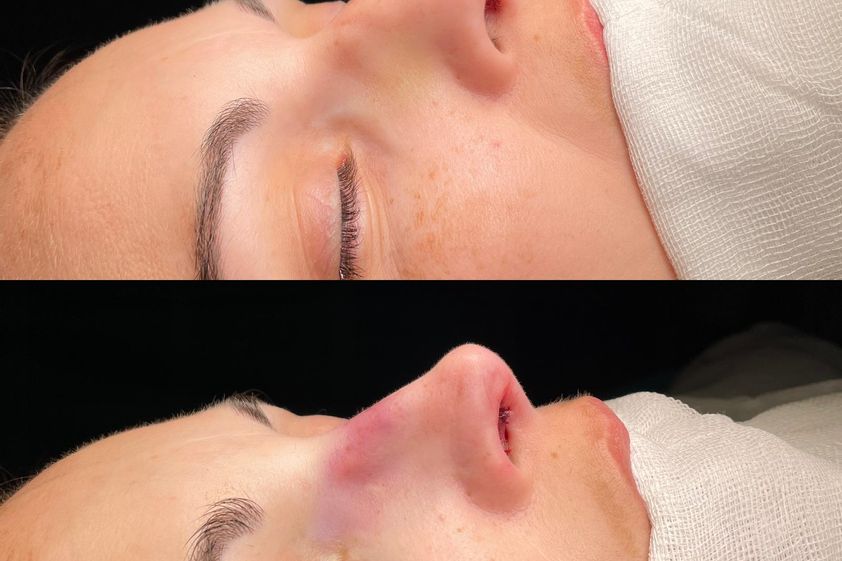 Rinoplastia antes y después - 857453