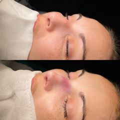 Rinoplastia - Fasent. Dr Rolando de la Garza Giacomán