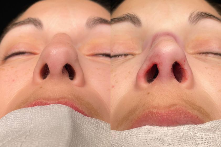 Rinoplastia antes y después - 857457