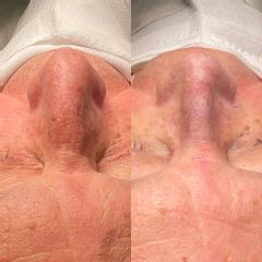 Rinoplastia - Dr. Alberto Cuevas