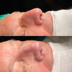 Rinoplastia - Dr. Alberto Cuevas