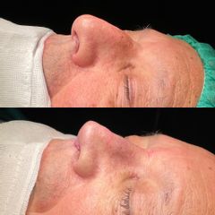 Rinoplastia - Dr. Alberto Cuevas