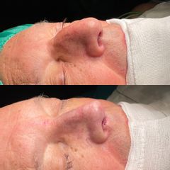 Rinoplastia - Dr. Alberto Cuevas