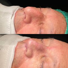 Rinoplastia - Dr. Alberto Cuevas