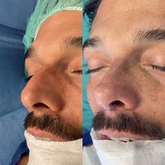 Rinoplastia - Dr. Alberto Cuevas