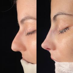 Rinoplastia - Dr. Alberto Cuevas