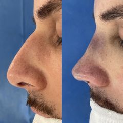 Rinoplastia - Dr. Alberto Cuevas