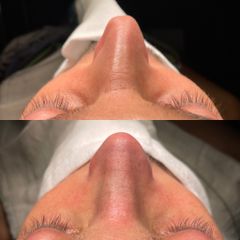 Rinoplastia - Dr. Alberto Cuevas
