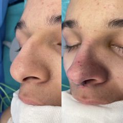 Rinoplastia - Dr. Alberto Cuevas