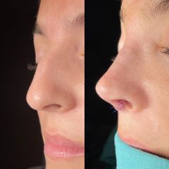 Rinoplastia - Dr. Alberto Cuevas