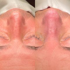 Rinoplastia - Dr. Alberto Cuevas