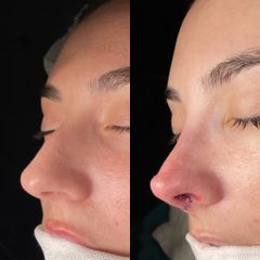 Rinoplastia - Dr. Alberto Cuevas