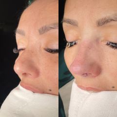 Rinoplastia - Dr. Alberto Cuevas