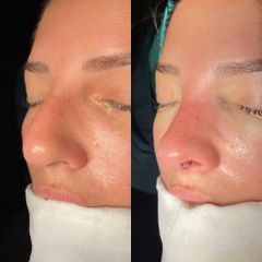 Rinoplastia - Dr. Alberto Cuevas