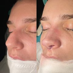 Rinoplastia - Dr. Alberto Cuevas