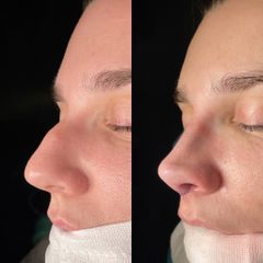 Rinoplastia - Dr. Alberto Cuevas