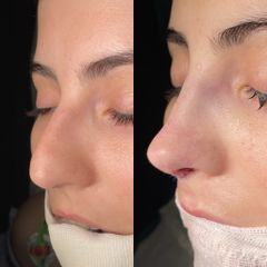 Rinoplastia - Dr. Alberto Cuevas