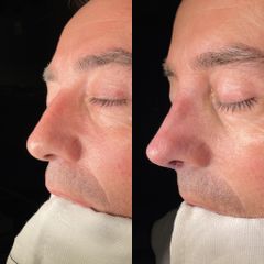 Rinoplastia - Dr. Alberto Cuevas