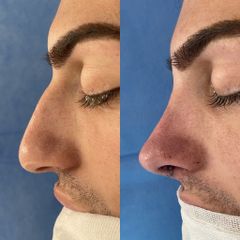 Rinoplastia - Dr. Alberto Cuevas