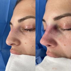 Rinoplastia - Dr. Alberto Cuevas