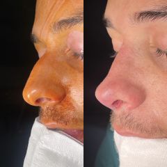 Rinoplastia - Dr. Alberto Cuevas