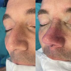 Rinoplastia - Dr. Alberto Cuevas