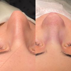 Rinoplastia - Dr. Alberto Cuevas