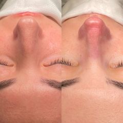 Rinoplastia - Dr. Alberto Cuevas