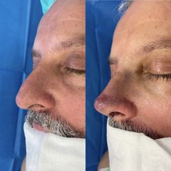 Rinoplastia - Dr. Alberto Cuevas