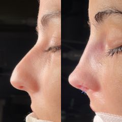 Rinoplastia - Dr. Alberto Cuevas