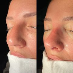 Rinoplastia - Dr. Alberto Cuevas