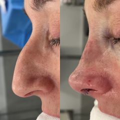 Rinoplastia - Dr. Alberto Cuevas