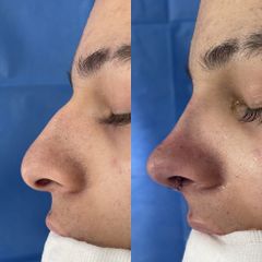Rinoplastia - Dr. Alberto Cuevas