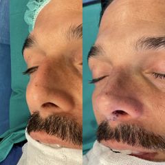Rinoplastia - Dr. Alberto Cuevas
