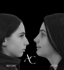 Rinoplastia - Dr. Alberto Cuevas
