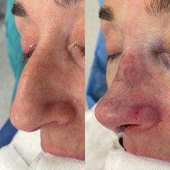 Rinoplastia - Dr. Alberto Cuevas