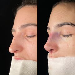 Rinoplastia - Dr. Alberto Cuevas