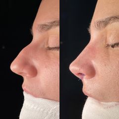 Rinoplastia - Dr. Alberto Cuevas