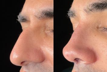 Rinoplastia - Dr. Alberto Cuevas